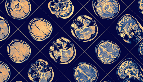 Il gene legato al morbo di Parkinson ha un doppio volto