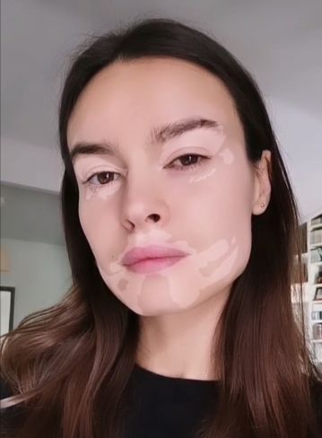 Kasia Smutniak vitiligine Kasia Smutniak vitiligine