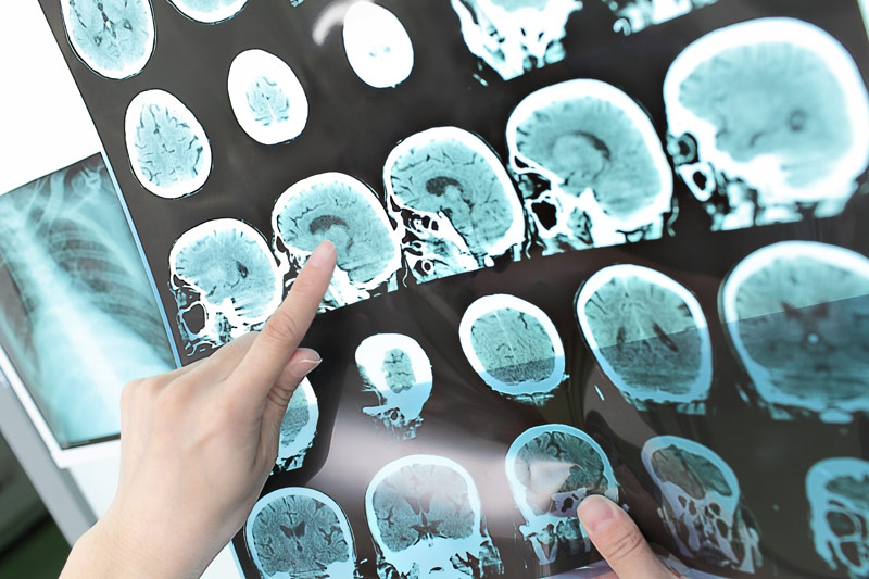 Tumore al cervello: dove curarsi?