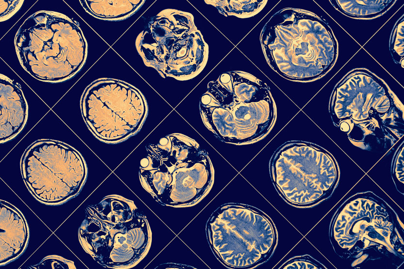 Alzheimer: la mappatura Alzheimer: la mappatura